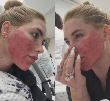 Imagem - Virginia Fonseca reaparece após reação intensa a procedimentos estéticos no rosto