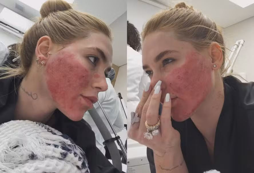 Virginia Fonseca reaparece após reação intensa a procedimentos estéticos no rosto