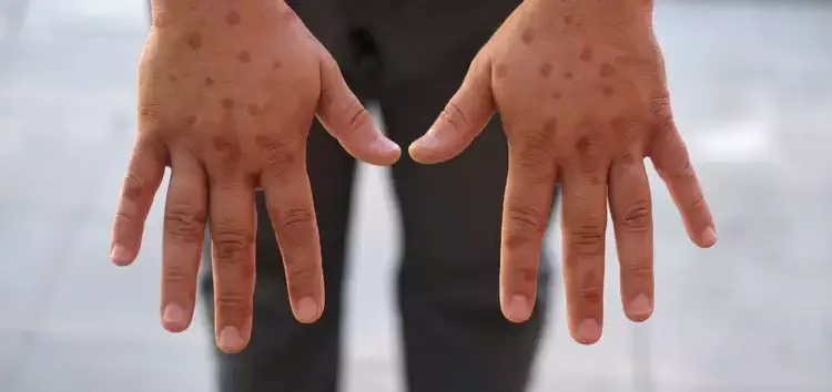 Porto Alegre confirma novo caso de Mpox e reforça alerta sanitário no Carnaval

