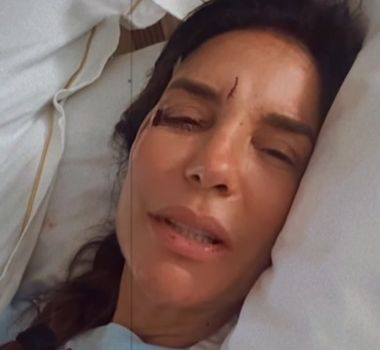Imagem - Ivete Sangalo surge com olho roxo após desmaiar e ser internada em hospital de Salvador