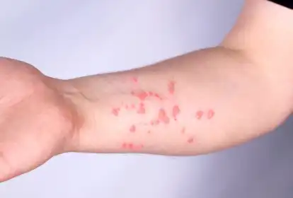 Estado de São Paulo contabilzia maioria dos casos

