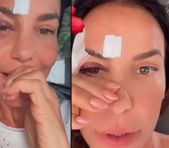 Imagem - Ivete Sangalo recebe alta após desmaio e brinca sobre olho roxo nas redes sociais