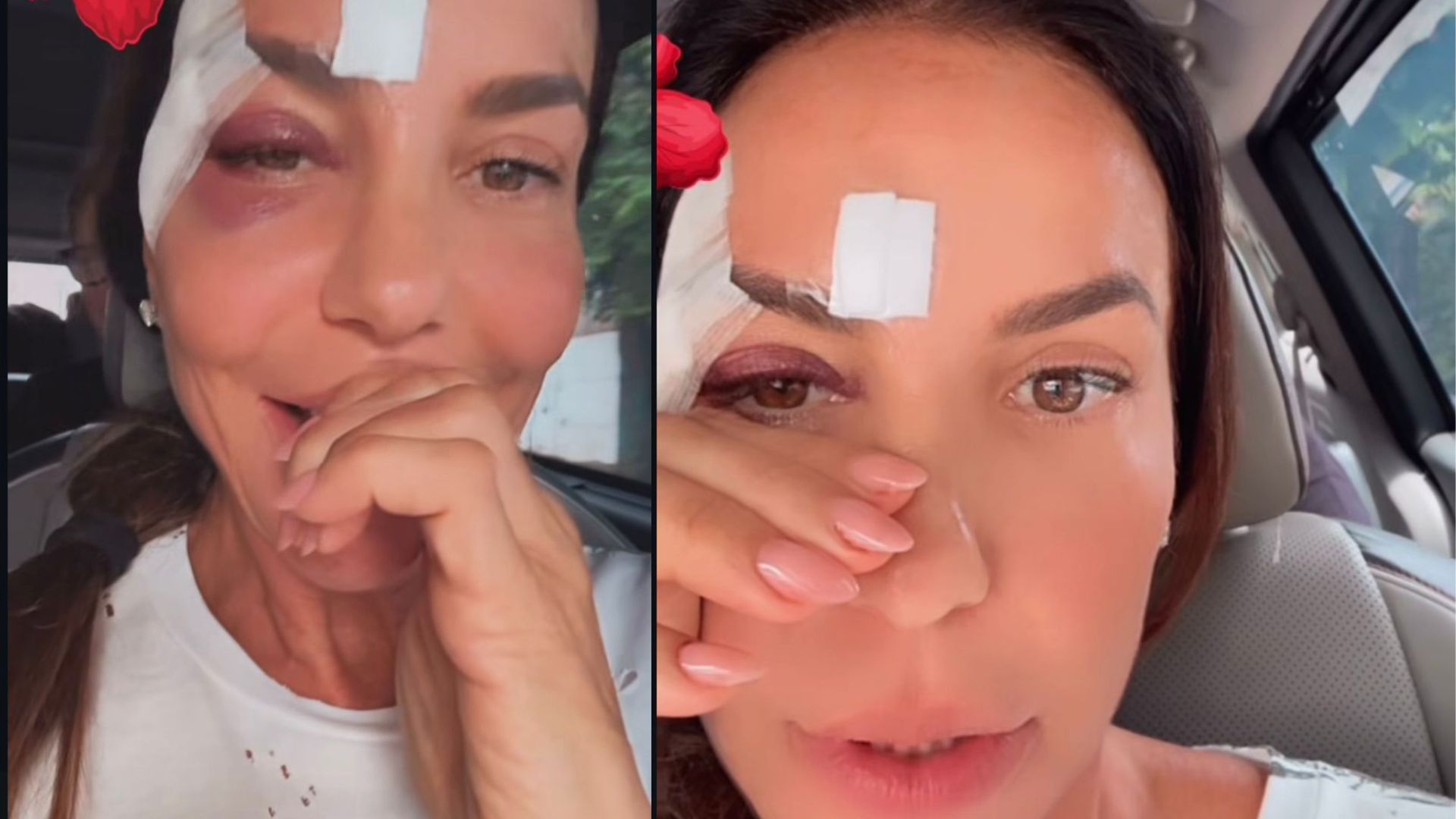 Ivete Sangalo recebe alta após desmaio e brinca sobre olho roxo nas redes sociais