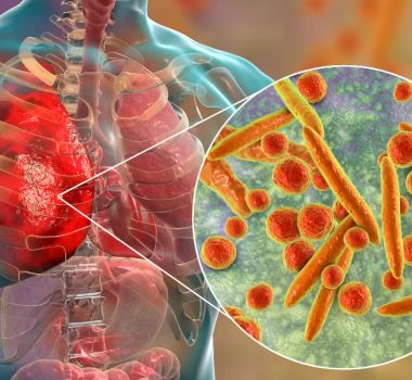 Imagem - Broncopneumonia: entenda quadro que causou internação de Bolsonaro