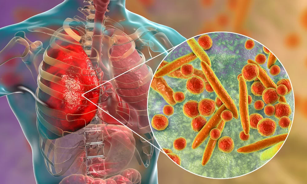 Tosse, febre, dor no peito e falta de ar estão entre os sintomas

