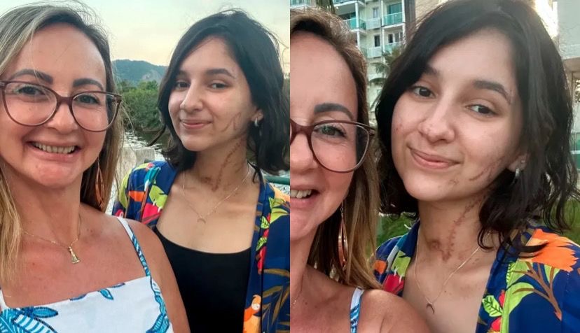 Alana ficou internada por quase um mês após o ataque, ocorrido no dia 6 de fevereiro, em São Gonçalo, no Rio de Janeiro