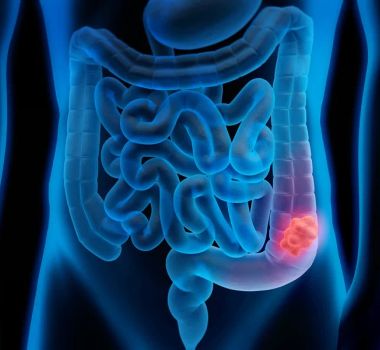 Imagem - SUS passa a usar novo exame para detectar câncer de intestino antes dos sintomas