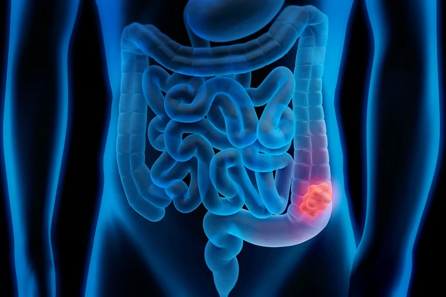 Imagem - SUS passa a usar novo exame para detectar câncer de intestino antes dos sintomas
