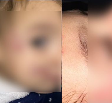 Imagem - Mãe aciona polícia contra creche particular após bebê sofrer múltiplas mordidas no rosto
