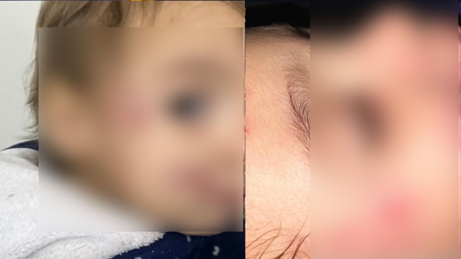 Mãe aciona polícia contra creche particular após bebê sofrer múltiplas mordidas no rosto

