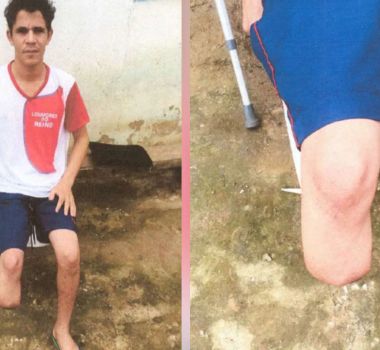 Imagem - Servidor é condenado após amputar o pé para receber seguro milionário na Bahia