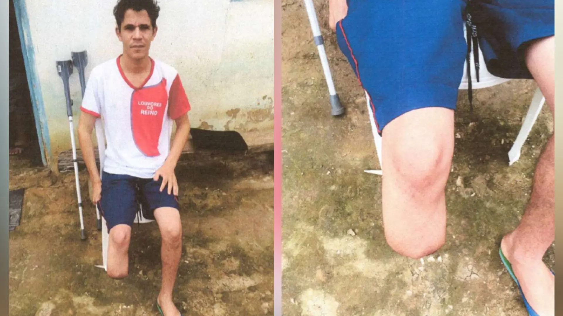 Servidor é condenado após amputar o pé para receber seguro milionário na Bahia - 