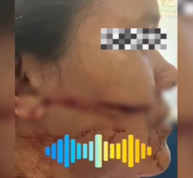 Imagem - Mulher sofre corte profundo no rosto após ser atingida por linha com cerol em Capanema