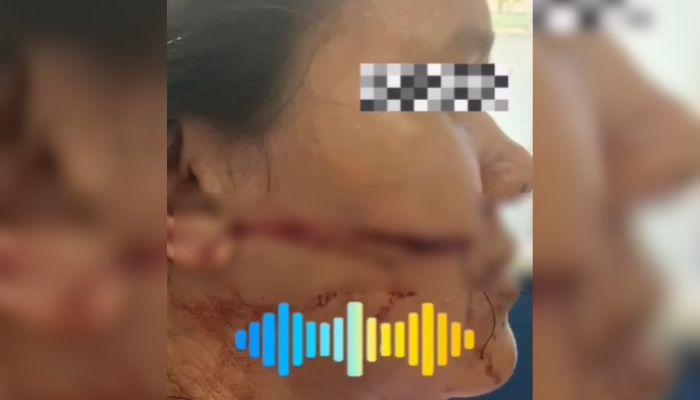 Imagem - Mulher sofre corte profundo no rosto após ser atingida por linha com cerol em Capanema