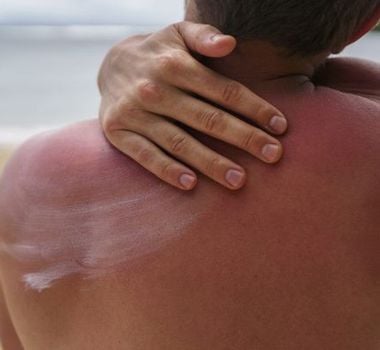 Imagem - Calor e banhos frequentes aumentam risco de alergias na pele durante o verão; veja como se proteger