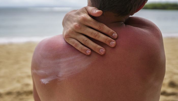 Imagem - Calor e banhos frequentes aumentam risco de alergias na pele durante o verão; veja como se proteger