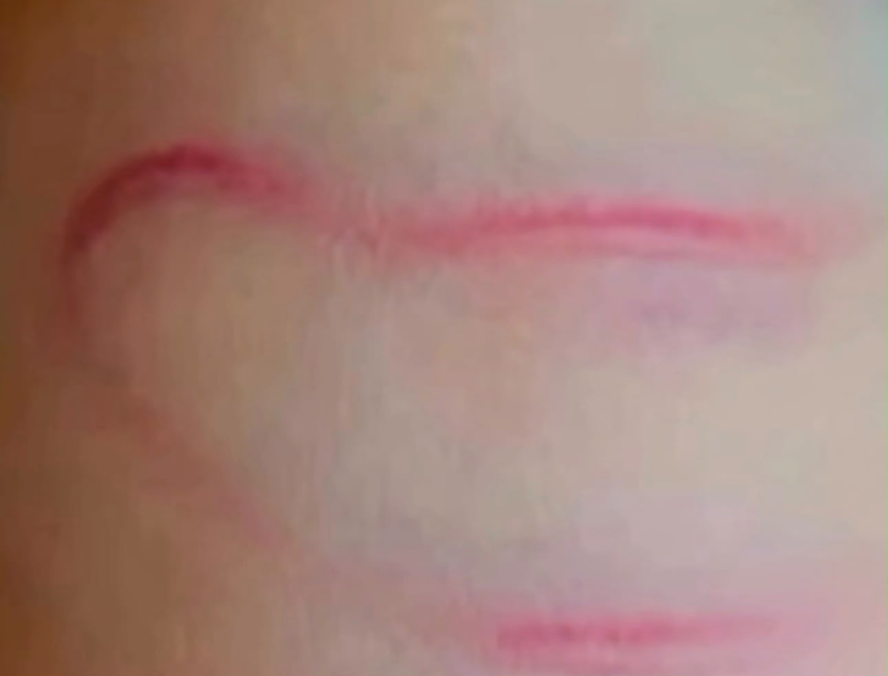 Marca de hematoma na criança -