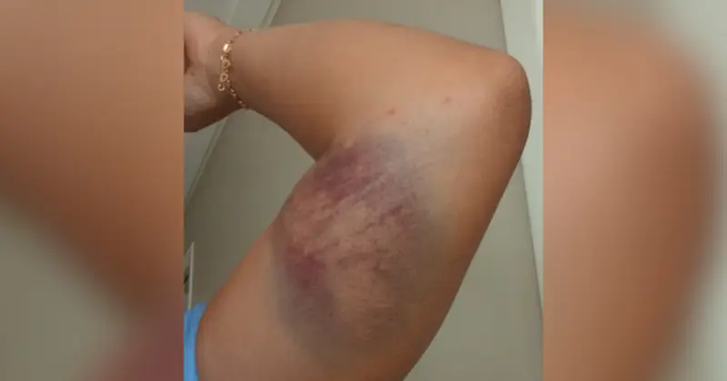 Mulher afirma que perdeu a consciência após ingerir uma bebida durante a madrugada e acordou horas depois com hematomas, dores nas partes íntimas e sem lembrar do que aconteceu. 