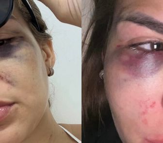 Imagem - Mulher denuncia agressões de ex-namorado durante viagem ao Marajó e expõe caso nas redes sociais