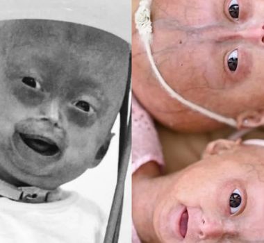 Imagem - Elis, menina de 5 anos com doença rara, morre em Boa Vista, Roraima