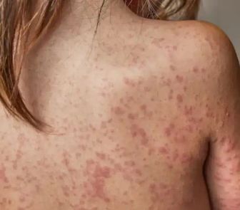 Imagem - Brasil intensifica monitoramento contra o sarampo diante do avanço da doença nos EUA