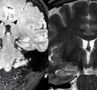Imagem - Com convulsões na menstruação, mulher tinha endometriose no cérebro