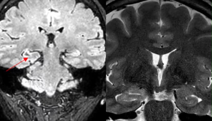 O padrão chamou a atenção dos médicos e levantou uma hipótese rara: endometriose no cérebro